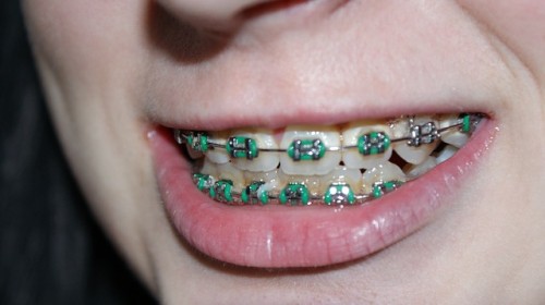 teeth with braces