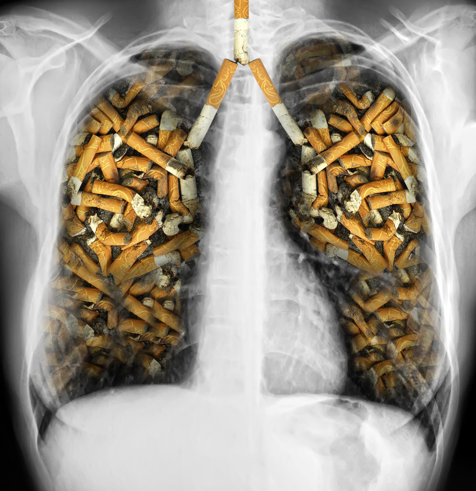10 Countries With the Highest Rates of Lung Cancer in the World
