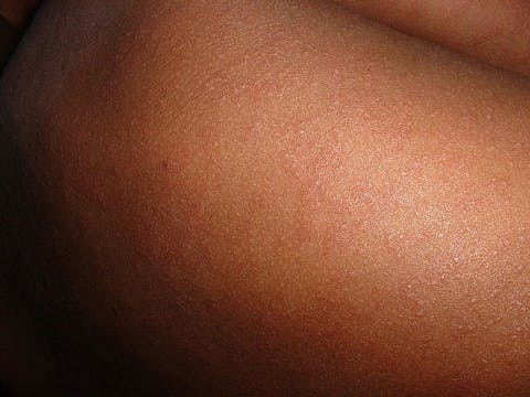 Top 10 Deadly Diseases Cured in the 20th Century Measles