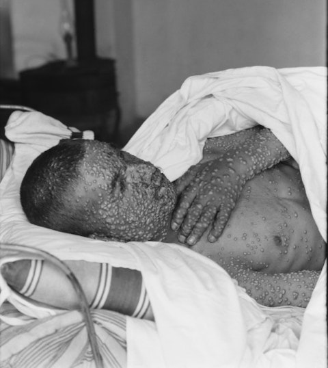 Top 10 Deadly Diseases Cured in the 20th Century - SmallPox