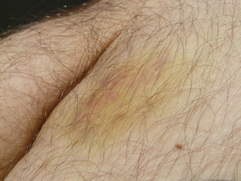 blue-blot-62407_1280