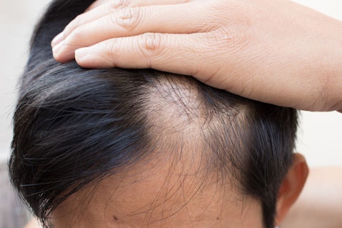 20 Countries with Highest Rates of Hair Loss